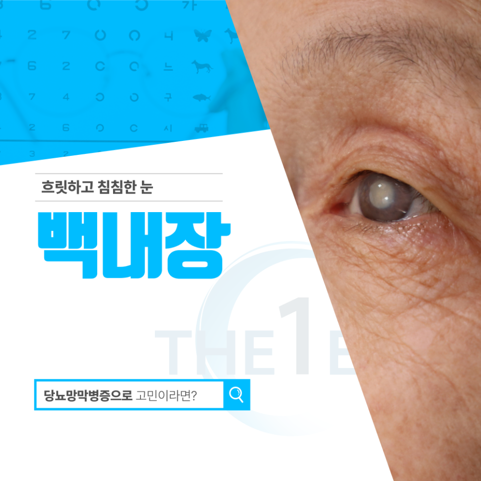 백내장 초기증상 시야 선명도가 서서히 달라지는 과정